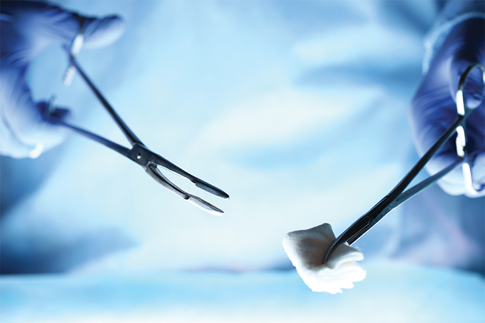 objetos intracavit&aacute;rios