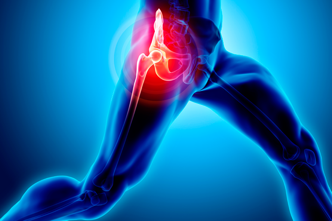 pr&oacute;tese no quadril