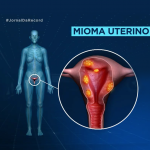 tratamento de miomas