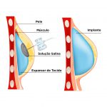 Novo expansor com rastreamento