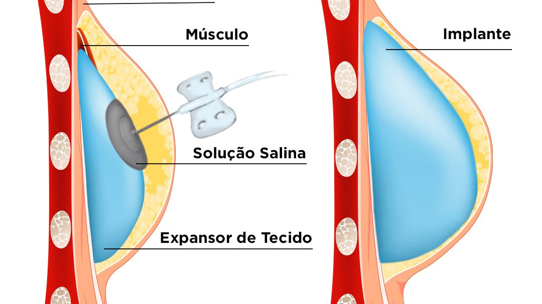 Novo expansor com rastreamento