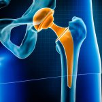 Prótese de quadril: quando é indicada e como é a volta aos treinos?