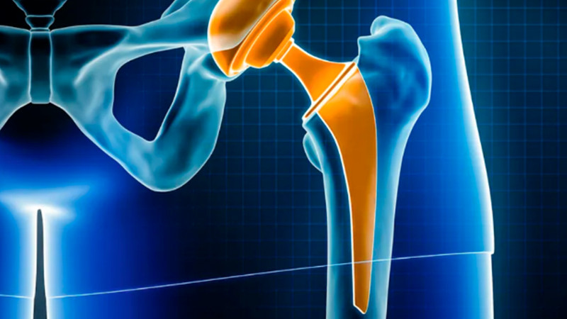 Prótese de quadril: quando é indicada e como é a volta aos treinos?