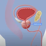 Preconceito ainda é barreira na prevenção ao câncer de próstata