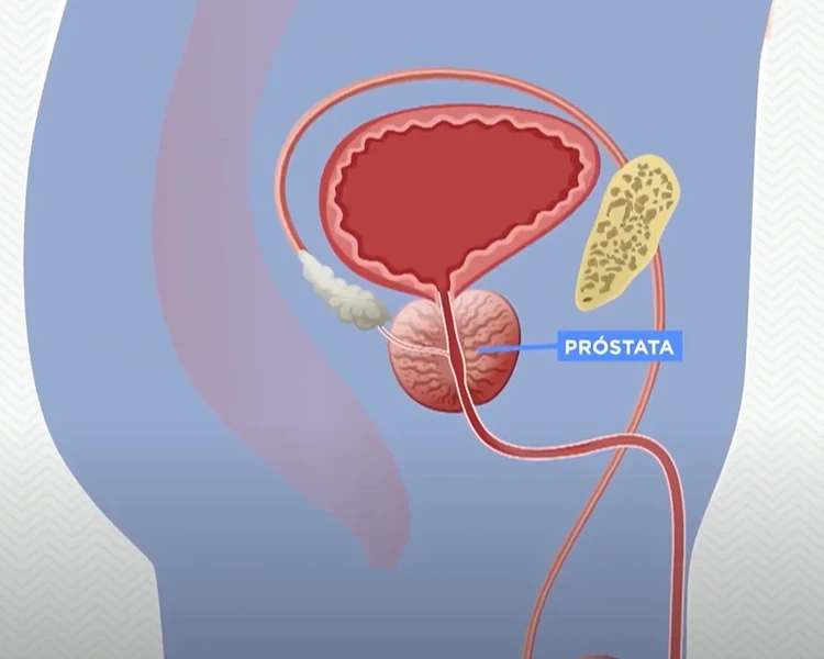 Preconceito ainda é barreira na prevenção ao câncer de próstata