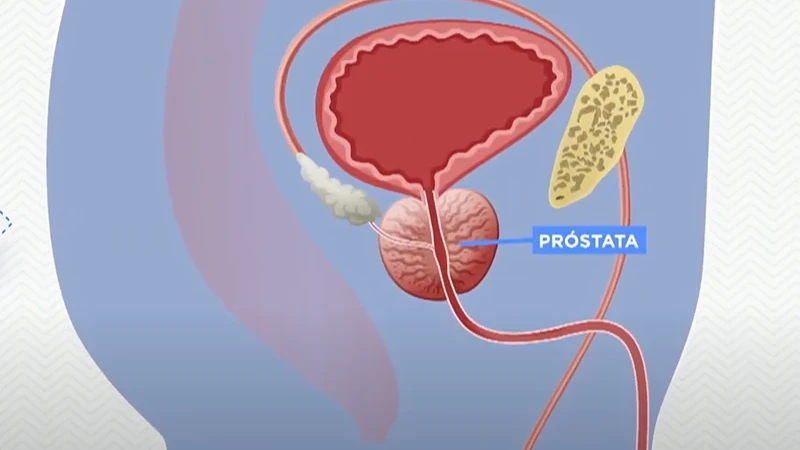Preconceito ainda é barreira na prevenção ao câncer de próstata