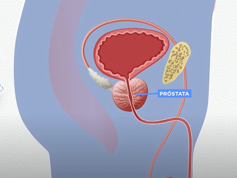 Preconceito ainda é barreira na prevenção ao câncer de próstata